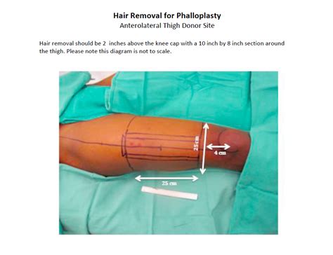 Phalloplasty